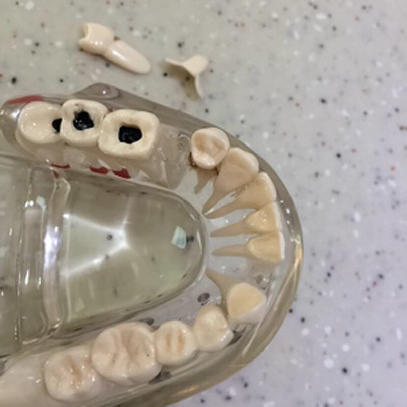 مواد طب الأسنان القابلة للإزالة عن طريق الفم ، نموذج باثولوجي ، ديكور خاص ، عيادة شخصية ، تماثيل زخرفية