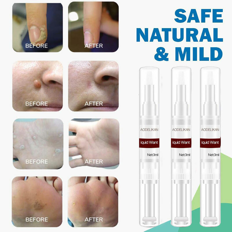 إزالة علامات الشامات مزيل 3 مللي الجلد العلامات الخلد مزيل صيغة فعالة لإزالة علامات الجلد NIN668