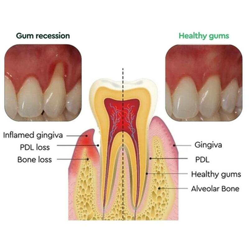 قطرات مصل إصلاح اللثة ، وتخفيف اللثة الانحسار ، ورعاية بثور الأسنان ، تبييض الأسنان ، وإزالة وجع الأسنان الأصفر ، معجون الأسنان