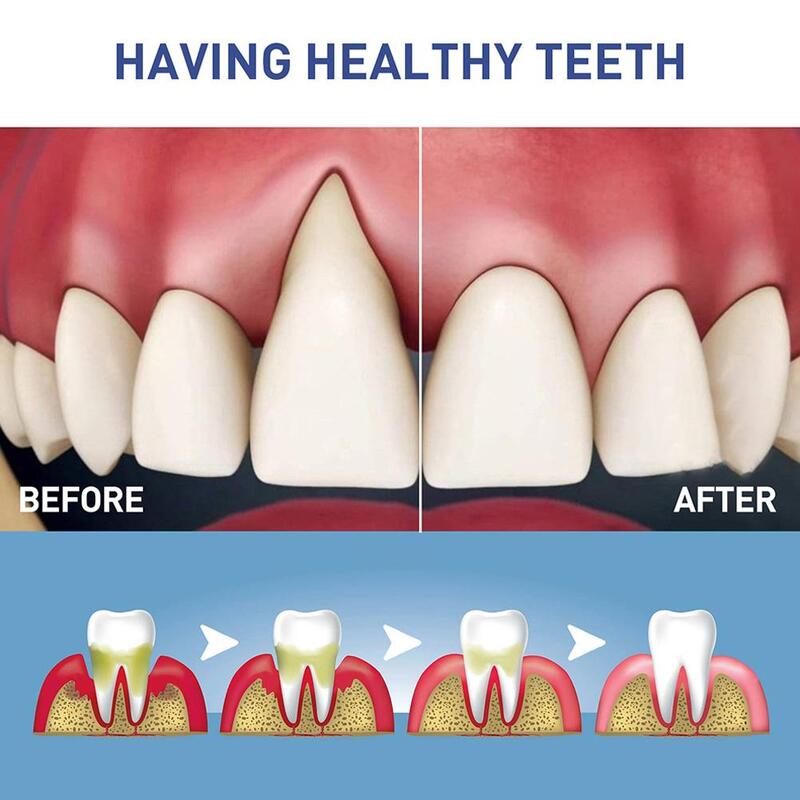 هلام الإغاثة اللثة لعلاج الأسنان ، ويخفف من التهاب اللثة ويبيض ، X2O2