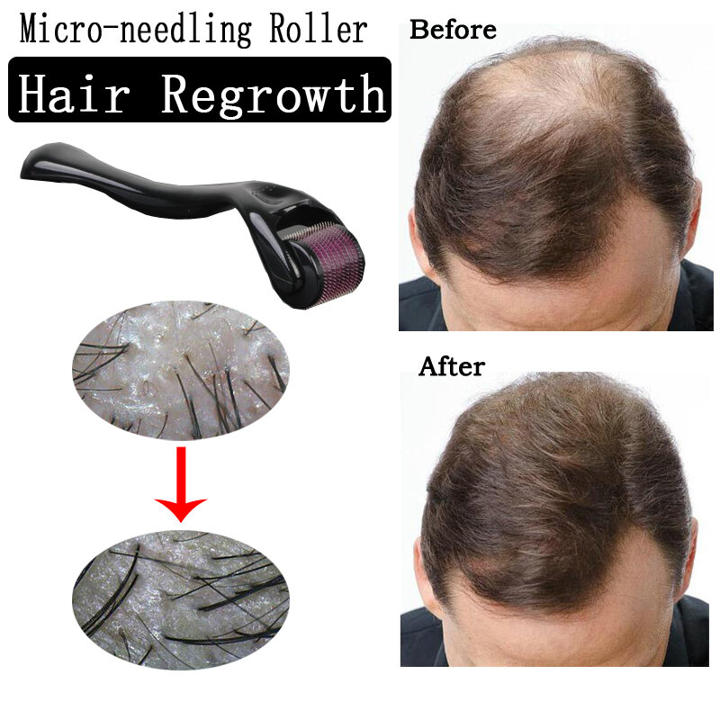 أداة العناية بالبشرة بإبرة دقيقة لإعادة نمو الشعر من ديرما رولر 540 علاج لتساقط الشعر