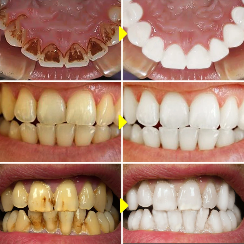 V34 معجون أسنان لتبييض الأسنان ، وإزالة بقع البلاك ، والتنظيف ، ونظافة الفم ، وتبييض أدوات الأسنان ، والتنفس الطازج ، والعناية بالأسنان