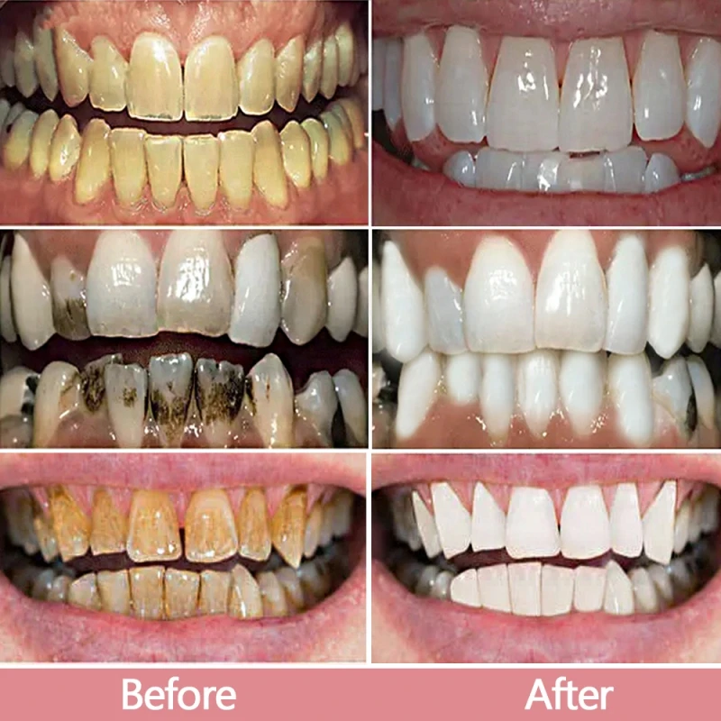 V34 سيروم معجون أسنان مبيض ، إزالة بقع البلاك ، نظافة الفم ، التنظيف ، أدوات تبييض الأسنان ، التنفس الطازج ، العناية بالأسنان