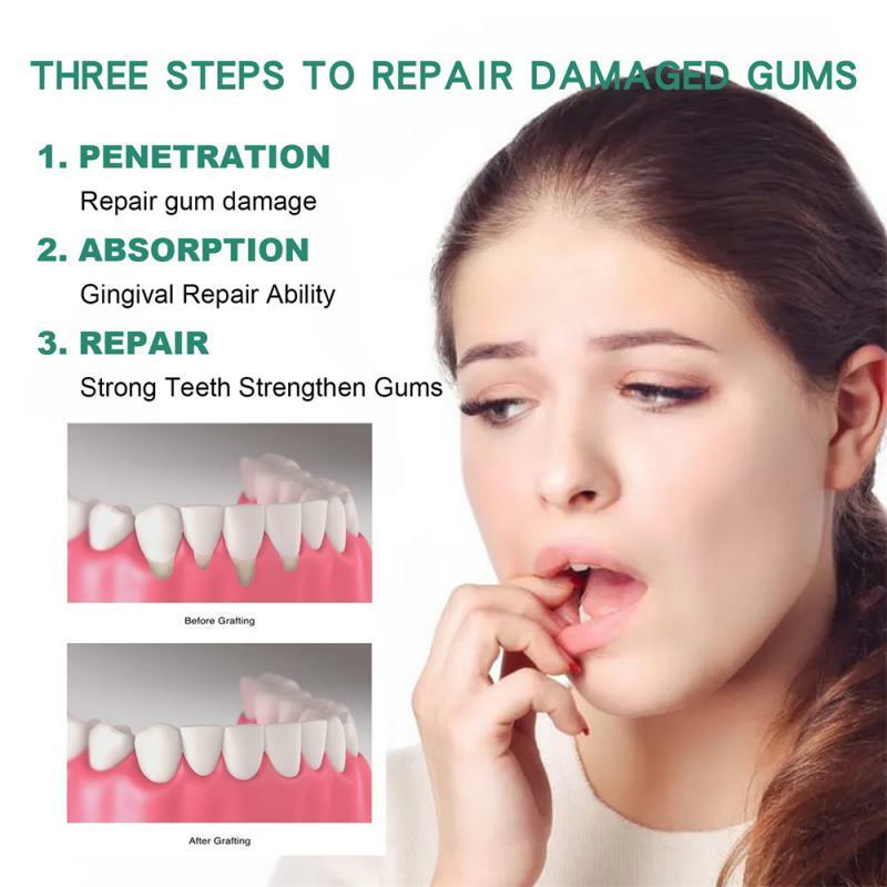 قطرات مصل إصلاح اللثة ، وتخفيف اللثة الانحسار ، ورعاية بثور الأسنان ، تبييض الأسنان ، وإزالة وجع الأسنان الأصفر ، معجون الأسنان