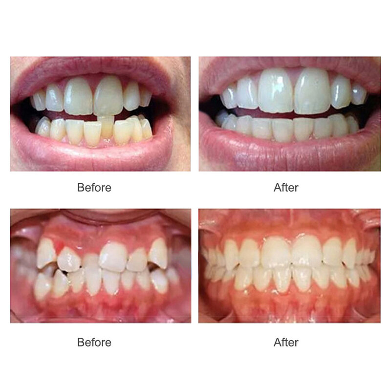 طقم مدرب أسنان لتقويم الأسنان للأشخاص البالغين جهاز تقويم الأسنان لمحاذاة 3 مراحل صينية لتقويم الأسنان