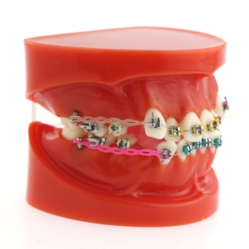 علاج الأسنان تقويم الأسنان نموذج تصحيح سوء القمع مع الأقواس المعدنية نموذج التدريس لعرض المريض
