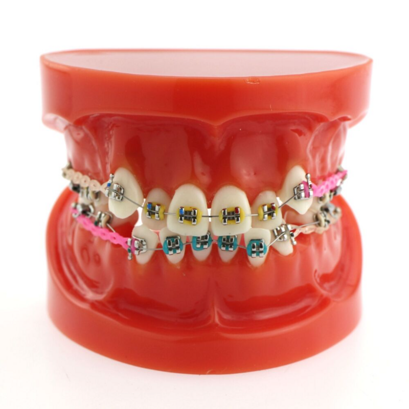 علاج الأسنان تقويم الأسنان نموذج تصحيح سوء القمع مع الأقواس المعدنية نموذج التدريس لعرض المريض
