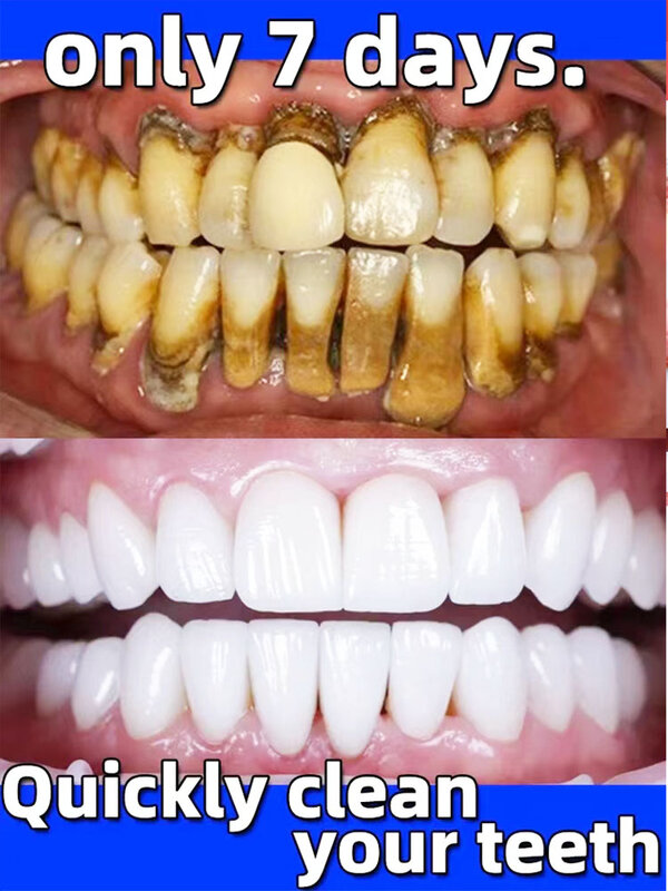 معجون تبييض الأسنان ، مزيل حساب التفاضل والتكامل للأسنان ، إزالة رائحة الفم ، رائحة الفم الكريهة ، التهاب اللثة ، الفلوريد