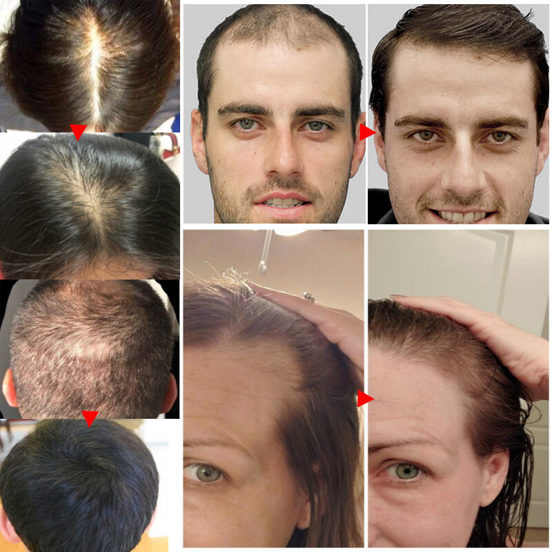 الزنجبيل نمو الشعر الزيوت الأساسية تعزيز إعادة نمو الشعر جوهر منع الصلع فقدان الشعر مصل الشعر إصلاح العناية بالشعر التالفة