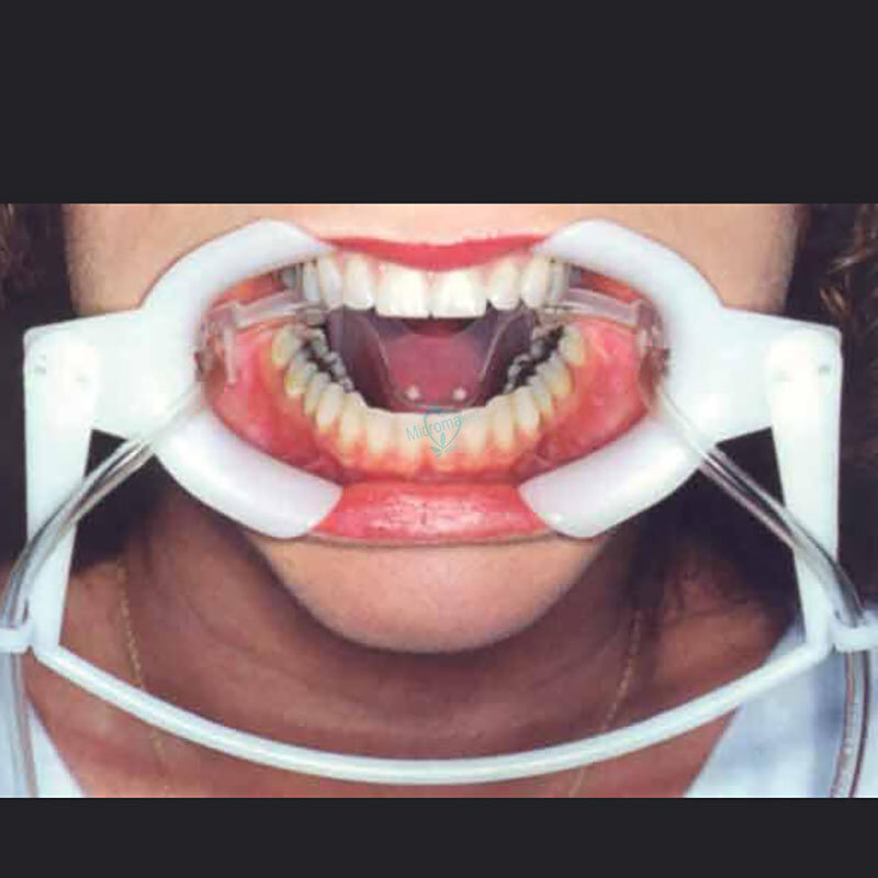 1 قطعة ضام الأسنان مع اللعاب الفرعي داخل الفم الخد ضام الفم فتاحة الخد توسيع طب الأسنان عن طريق الفم الجاف