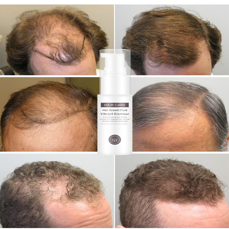 سريع نمو الشعر رذاذ جوهر الزيوت الزنجبيل فقدان الشعر العلاج ل ترقق منتجات الشعر السائل الشعر الرعاية الصحية للرجال النساء
