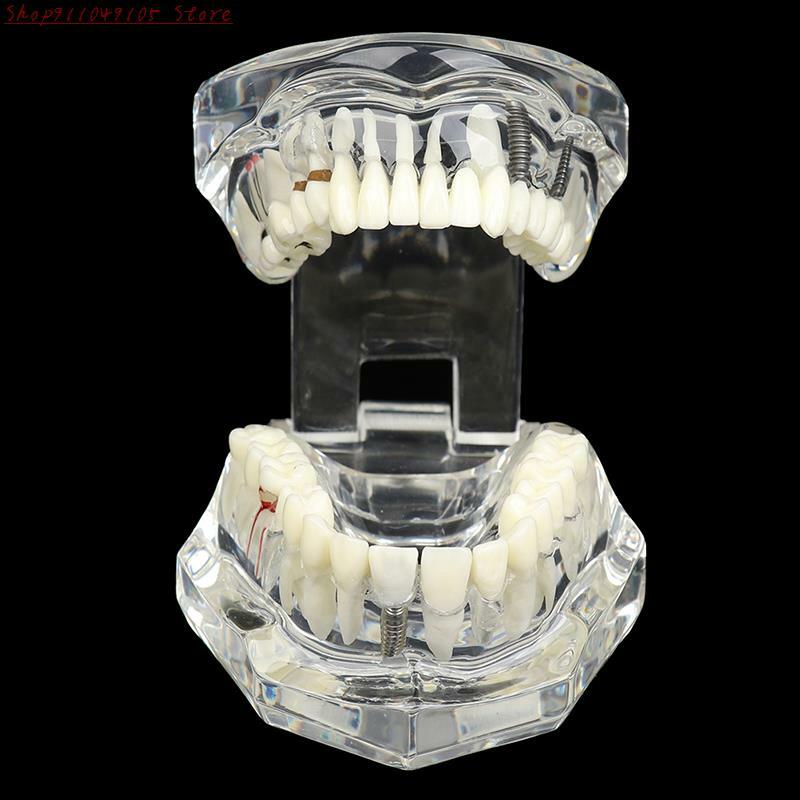 نموذج الأسنان زرع الأسنان ترميم جسر التدريس لدراسة علم الأسنان