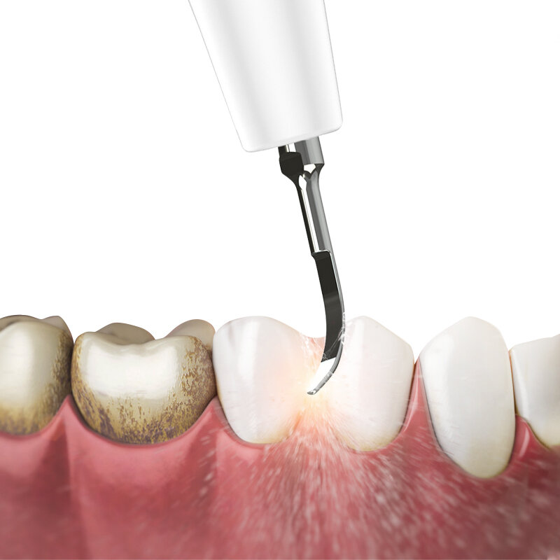 الكهربائية المنزلية الأسنان sacler نظافة الأسنان العناية بالأسنان سونيك الكهربائية نظيفة حل مشكلة الفم