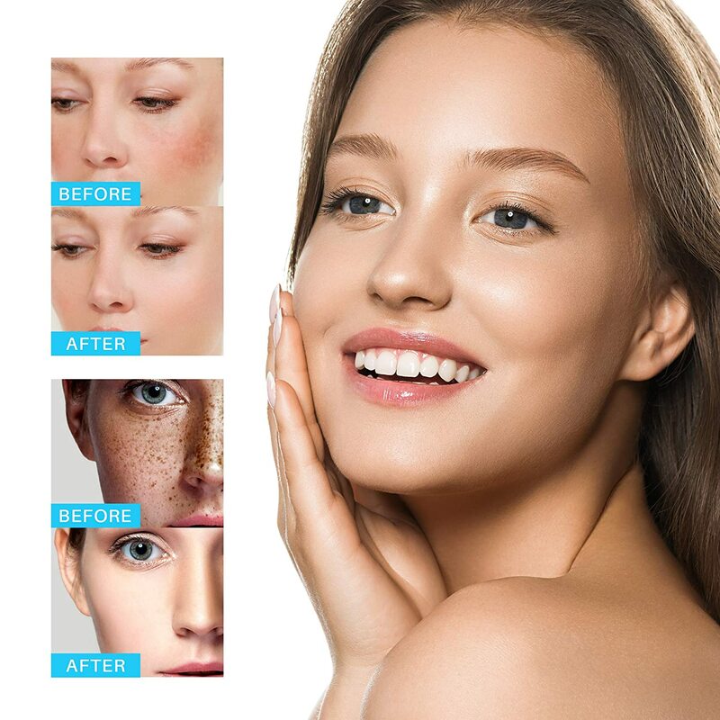 تبييض النمش كريم الوجه ترطيب إزالة البقع الداكنة الميلانين الميلازما مزيل اشراق الجلد إصلاح فعال مكافحة الشيخوخة