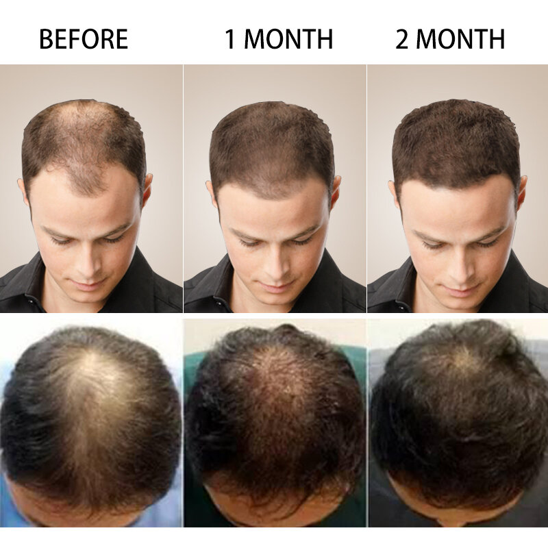 سريع نمو الشعر رذاذ جوهر الزيوت الزنجبيل فقدان الشعر العلاج ل ترقق منتجات الشعر السائل الشعر الرعاية الصحية للرجال النساء
