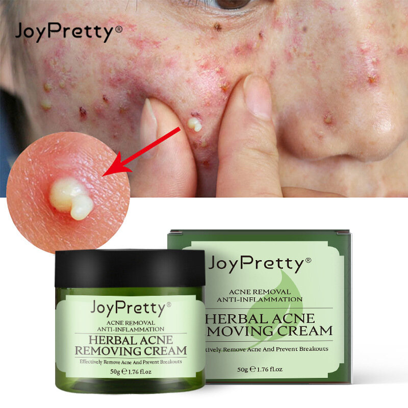 JoyPretty علاج حب الشباب الوجه الكريمات النفط السيطرة مكافحة بثرة الوجه الكريمات تقليص المسام ترطيب النبات كريم الوجه العناية بالبشرة