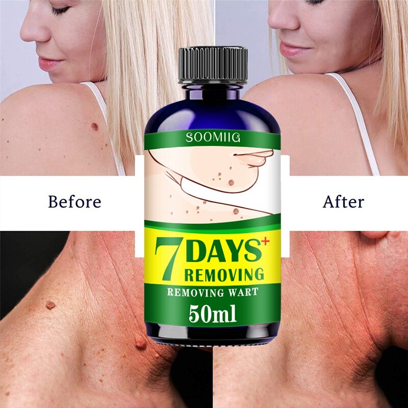 50mlTreatment Papillomas Removal of Warts Liquid kill Remover Foot Corn Skin Tag Mole &amp Genital Wart Remover Remedy Skin Care
