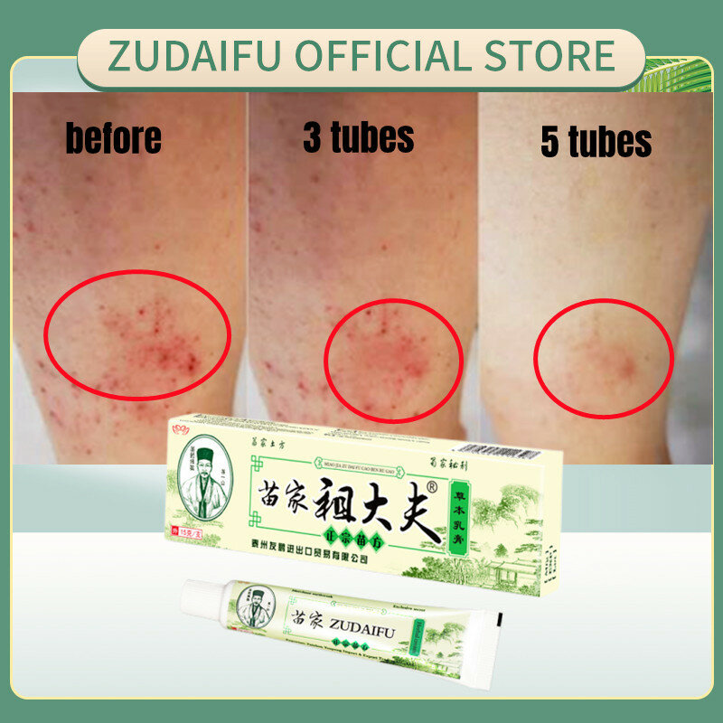 مرهم ل Zudaifu الصدفية كريم إزالة الفطريات كريم الحكة مسحوق مرهم من الصدفية علاج الجسم العناية بالبشرة