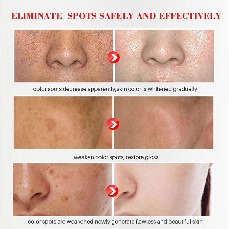 20ml Whitening Freckle Cream Face Remove Dark Spots Melanin Melasma Remover Brightening Skin Effective Repair Anti-Aging Cream