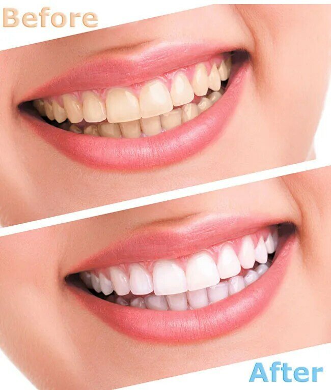 دروبشيب جل تبييض الأسنان 44% بيروكسيد تبييض الأسنان جل عن طريق الفم عدة مبيض الأسنان معدات طب الأسنان بالجملة