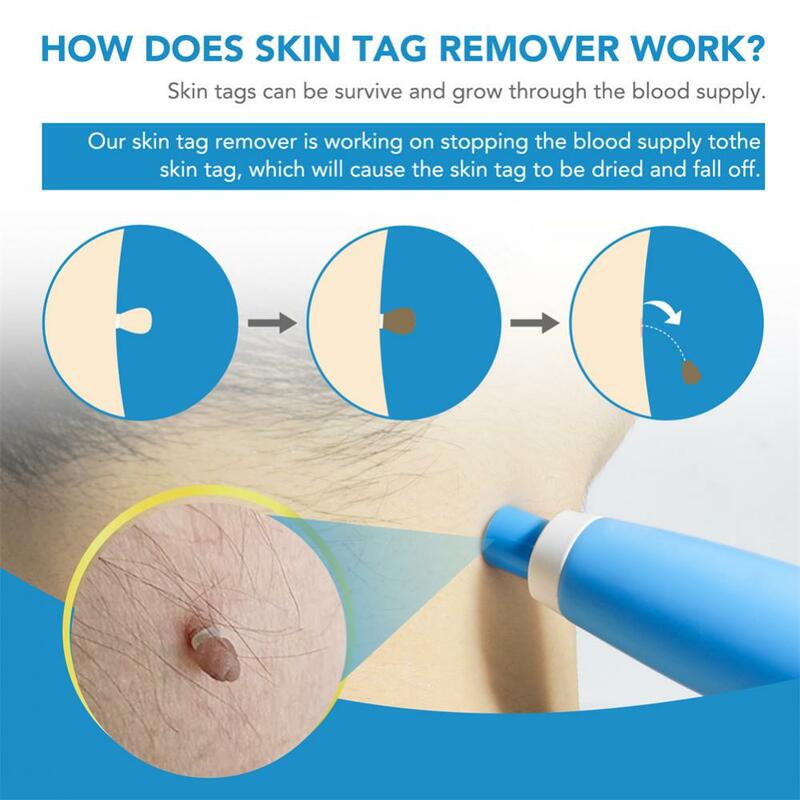 مزيل لعلامات الجلد الأوتوماتيكي 2 في 1 غير مؤلم مزيل لثؤلول الجلد مزيل لعلامات الجلد قلم لإزالة ثؤلول نقطة علاجات الذرة الأخمصي أداة تجميل الوجه