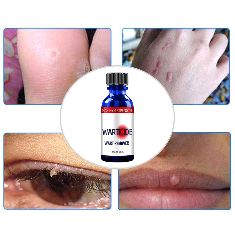 Skin Tag Remover Medical Against Moles Removal Genital Wart Acne Spot Treatment Anti Foot Corn Skin Care Liquid